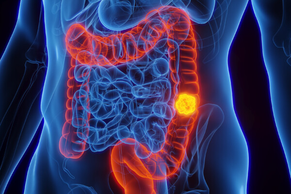 3D Rendered Medical Illustration of Male Anatomy showing Colorectal Cancer