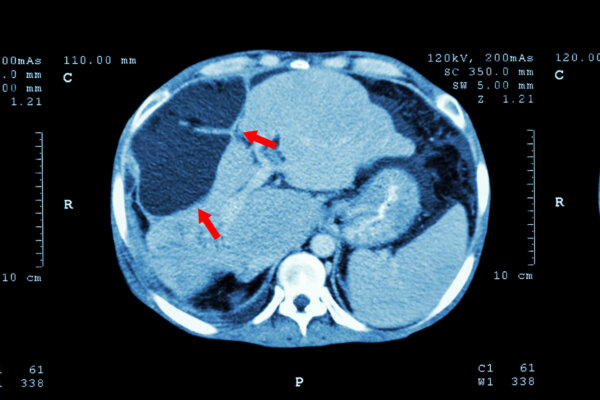 CT scan of upper abdomen shows abnormal mass at liver, potentially cancer.