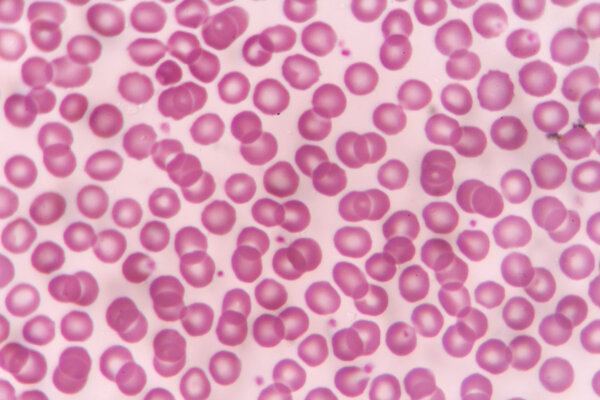 Normal red blood cells under the microscope.