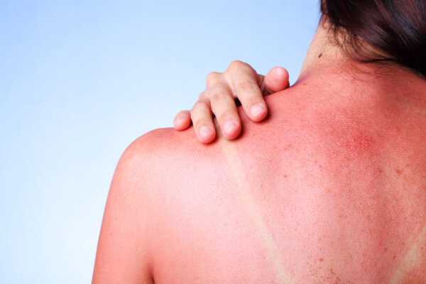 Woman touching her sunburned shoulder
